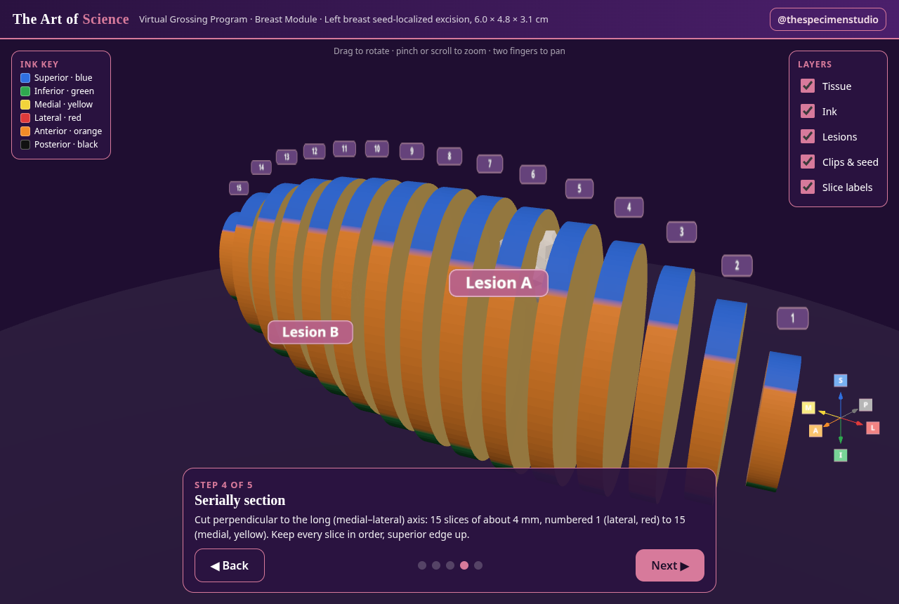 Screenshot of the 3D breast excision demo showing serial sections